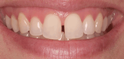 There's no reason to put up with gaps in your teeth or with teeth that are stained, discolored, badly shaped, chipped, or crooked. Today, a veneer placed on top of your teeth can correct nature's mistake or the results of an injury and help you have a beautiful smile. Veneers are a highly popular solution among dental patients because of their life-like tooth appearance.
